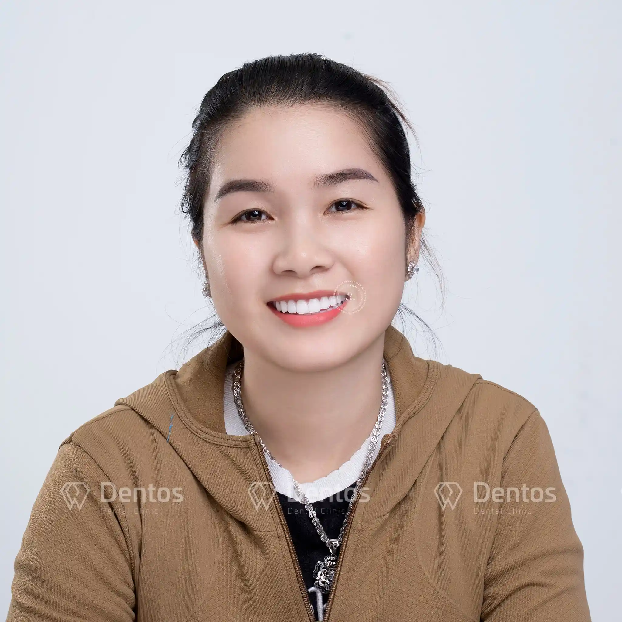 Quy trình thay răng sứ chỉ mất 2 - 3 lần hẹn, không đau đớn như bạn nghĩ